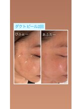 ノフ 恵比寿(noff)/bf/af【ダクトピール】