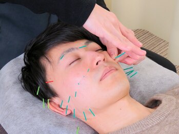 楓整骨院/男性にも大人気◎の美容鍼♪