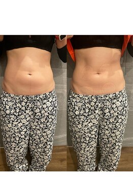 長寿鍼灸院 長寿整骨院/EMS＜お腹集中コース＞