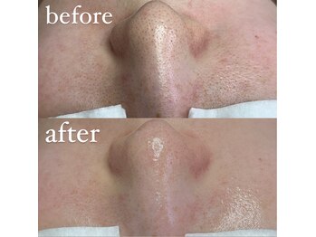 ダブル(W)/毛穴ケア×ハーブピーリング