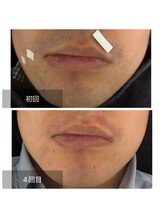 ダンニヒル(dannihil)/【ヒゲ脱毛】30代会社員4回目