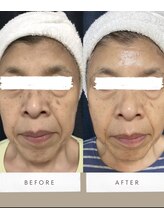 トータルケアラボ エムドットティ(m.t)/ホワイトスノーピール