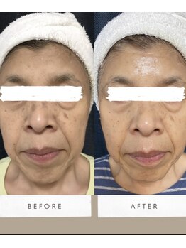 トータルケアラボ エムドットティ(m.t)/ホワイトスノーピール