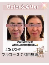 瑞 鍼灸院/瑞‐鍼灸フルコース　美容鍼