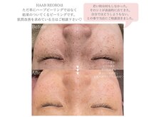 ビースタジオブランジュ(B STUDIO blange)/HAAB REPRO◇ハーブピーリング