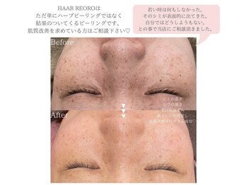 ビースタジオブランジュ(B STUDIO blange)/HAAB REPRO◇ハーブピーリング