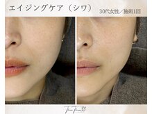 スリースリー 恵比寿(THREE THREE)/エイジングケア・しわ・たるみ