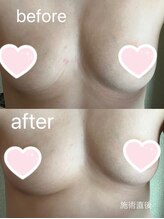 アイビークイーン(I.B.QUEEN)/光バストケアで産後バストも