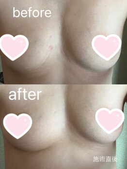 アイビークイーン(I.B.QUEEN)/光バストケアで産後バストも