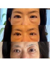 ミーティット(Meetite)/プラズマで目元のたるみ改善