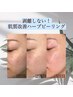 【毛穴ニキビケア美白】ハーブピーリング＋人幹細胞美容液付 ¥13,000