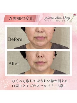 ドロップ(Drop)/50代小顔矯正　二重あごスッキリ