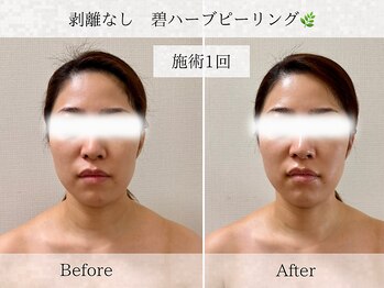 フラリ 西葛西(Hulali)/【30代】ハーブピーリング1回目