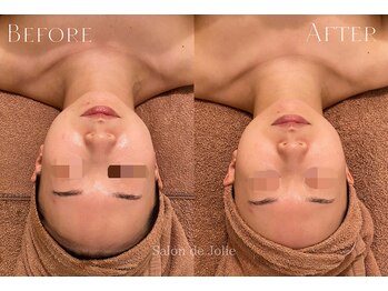 サロンドジョリー(Salon de Jolie)/【フェイシャルウィンバック】