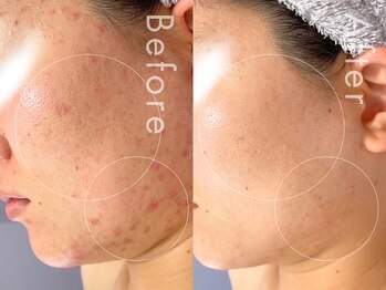 セルフミー 恵比寿(SELF Me...)/ハーブピーリング/ニキビケア