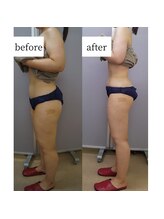 アップルミント/＜痩身＞before・after