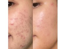 ニキビ・肌荒れ・ごわつくお肌にアプローチ！光フェイシャル