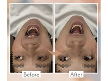 くすの木 治療院/ガッコンせずに口が開くように…