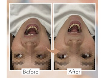 くすの木 治療院/ガッコンせずに口が開くように…