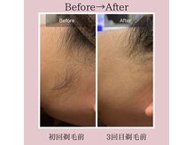 うなじ脱毛3回での変化☆