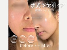 サロン ルイス アディクト(salon Lewis Addict)の雰囲気(小顔リフト/ソフウェーブ/たるみ/ほうれい線/ハーブピーリング)