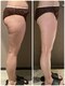 みるめ みための写真/【太もも・ヒップの凸凹にアプローチ◎】夏に向けての本格セル脂肪ケアを始めるなら今！！
