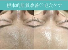 サロン ド ヒノキ(Salon de HINOKI)/毛穴ケアでトーンアップ