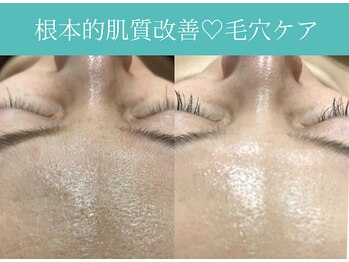 サロン ド ヒノキ(Salon de HINOKI)/毛穴ケアでトーンアップ