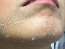 美肌研究所 東京新宿支店/施術２～３日目　剥離開始