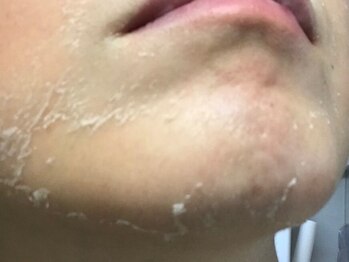 美肌研究所 東京新宿支店/施術２～３日目　剥離開始