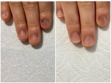 ネイルズシアム/深爪矯正