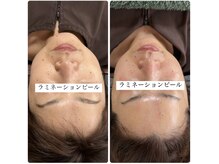 陽月 鍼灸院整骨院/美容鍼＋ラミネーションピール