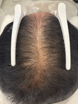 フォーケア(4Care)/プロセル頭皮改善トリートメント