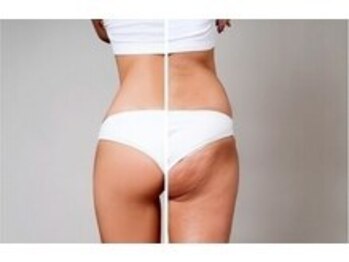ヨサパーク リナータ(YOSA PARK Rinata)の写真/痩せにくい太もも・腰周り脂肪をしっかりケア！下半身集中の痩身ケアコースで頑固な脂肪スッキリ♪