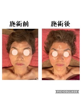 癒しの隠れ家サロン シュシュ(CHOU*CHOU)/フェイスリンパ90分施術前施術後