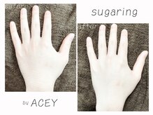エイシー(ACEY)/ビフォーアフター☆手の甲・指