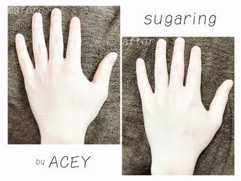 エイシー(ACEY)/ビフォーアフター☆手の甲・指