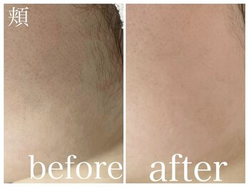毛穴塾/無添加フェイシャルWAX脱毛☆