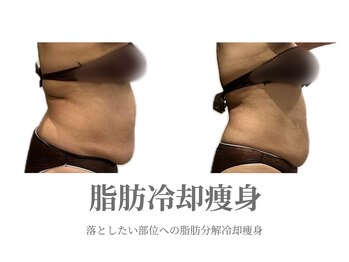 エクラ イオンモール徳島店(ECLAT)/脂肪冷却痩身