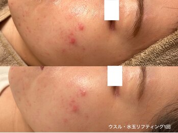 サロンヴェアリー 広尾(salon vary)/ニキビケア#跡#赤み