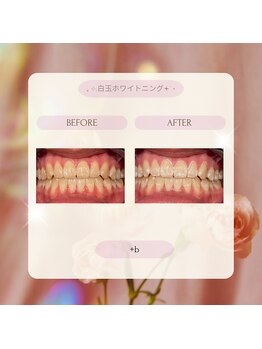プラスビー 2号店(+b)/ホワイトニングビフォーアフター