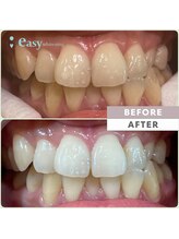 イージーホワイトニング 中野店(easy whitening)/セルフホワイトニング症例写真