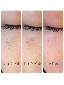 ギルドハナレ(GUILD HANARE)/"シミに集中ケア"