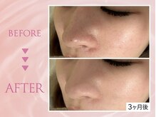 クリアラボ 池袋2nd(Clear Lab)/韓国肌管理&毛穴洗浄専門店