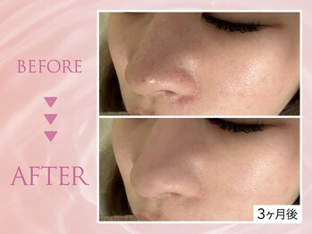 クリアラボ 池袋2nd(Clear Lab)/韓国肌管理&毛穴洗浄専門店