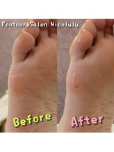 ニコルル 春日部店(Nicolulu)/魚の目ビフォーアフター