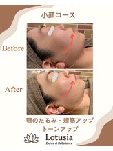 ルトゥーシア(Lotusia)/小顔　　before→after