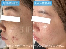 アクネラボ 梅田店(ACNE LABO)/もうニキビに悩まない！