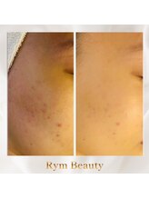リム ビューティー(RYM BEAUTY)/思春期ニキビにもダクトピール