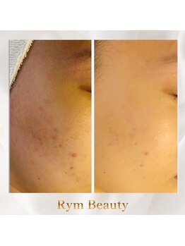 リム ビューティー(RYM BEAUTY)/思春期ニキビにもダクトピール